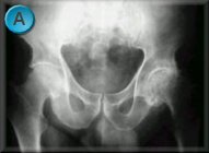 hip injuryies