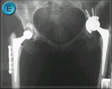 Hip replacement surgery